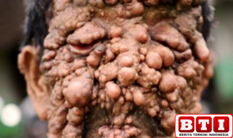 penyakit-langka-nf1-intai-anak-anak-kenali-gejalanya-sejak-dini